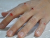 War wounds